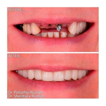 Restoration of anterior teeth on Neodent implants