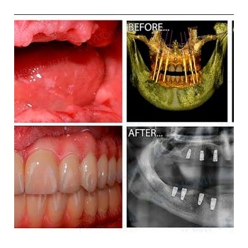Straumann All-on-6 Implant Treatment Result