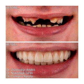 Dental implants before and after photos Kyiv Lumi-Dent 