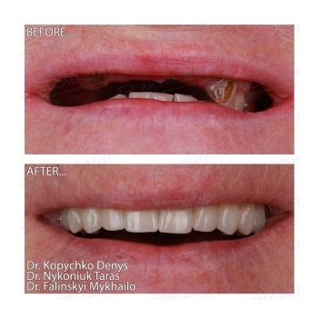 Upper jaw prosthetics using the All-on-6 Straumann method