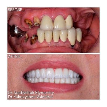 Implantation according to the All-on-6 protocol