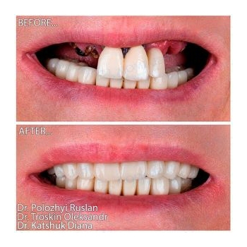 Straumann All-on-6 implantation on the upper jaw
