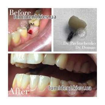 teeth implantation