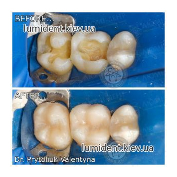 Before after tooth fillings photo Lumident