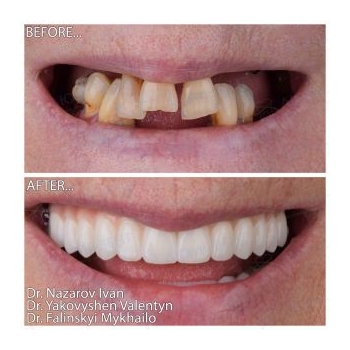 Zirconia dentures on titanium bars All-on-6 Straumann