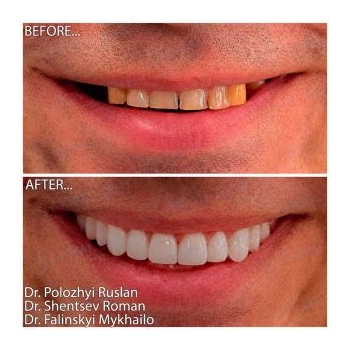 Straumann BLX SLActive Roxolid implants