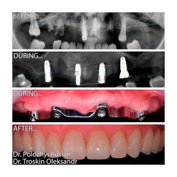 All-on-4 full dental implantation