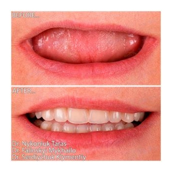 installation of Straumann implants on two jaws according to the All-on-4 concept