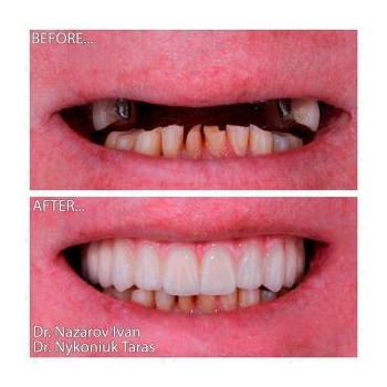 Neodent All-on-4 Implant Rehabilitation