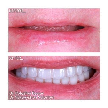 Full MegaGen AnyRidge implantation using the All-on-6 protocol