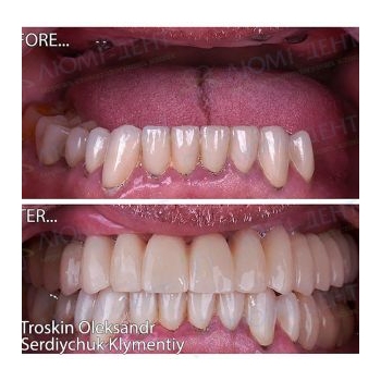 Teeth implantation foto before after Ukraine Kiev Lumident