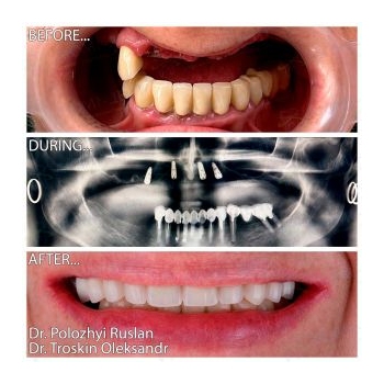 Upper jaw rehabilitation with the All-on-4 concept