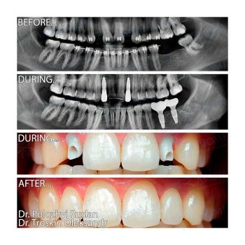 Zirconia crowns on Straumann implants