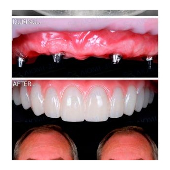 Straumann All-on-4 Upper Jaw Implant Rehabilitation