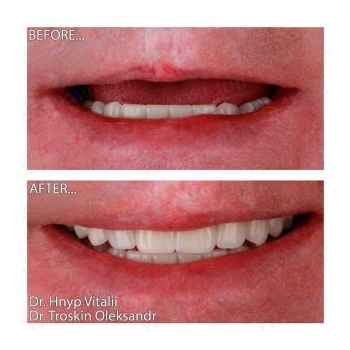 All-on-4 protocol on Neodent implants