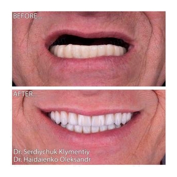 Full-jaw rehabilitation with Neodent implants