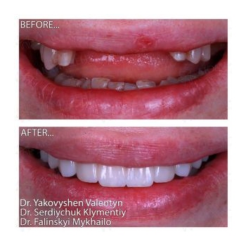 total rehabilitation according to the All-on-4 protocol on Neodent implants