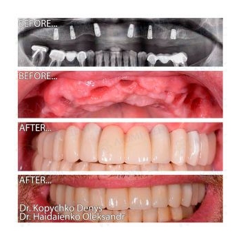 Zirconia prosthesis FP3 on a titanium bar All-on-6 Neobiotech