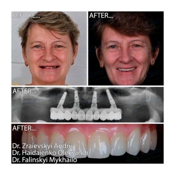 All-on-4 Upper Jaw Implant Rehabilitation