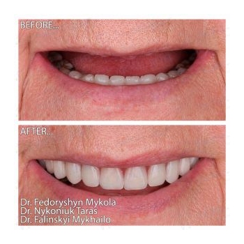 Zirconia prosthesis on a titanium bar All-on-4 MegaGen AnyRidge