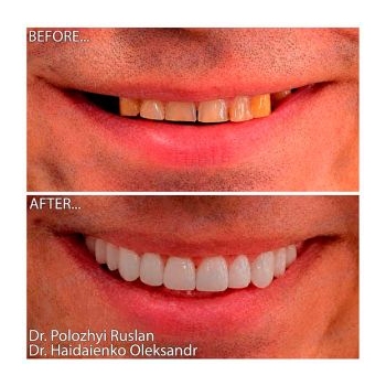 Straumann BLX SLActive Roxolid implants