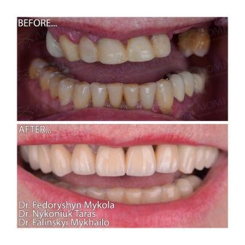Ceramic veneers and zirconia crowns on Nobel Biocare implants