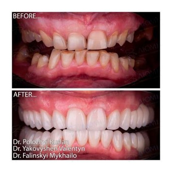 Before and after Straumann smile restoration