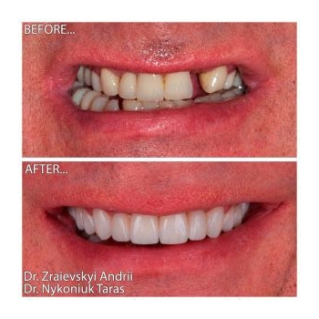 Before and after anterior tooth implantation