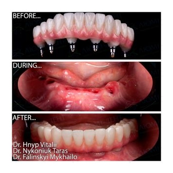 Zirconia prosthesis on a titanium bar All-on-6 Straumann BLX Roxolid