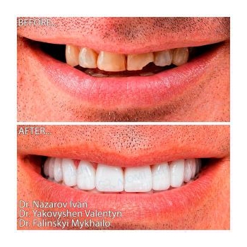 Straumann Implant Placement with Sinus Lift
