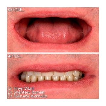 Zirconia prostheses on a titanium bar with the All-on-4 concept