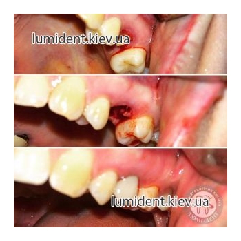 имплантация зубов киев