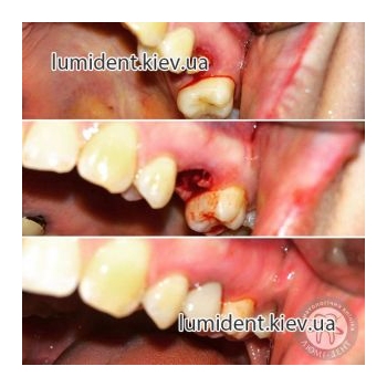 teeth implantation