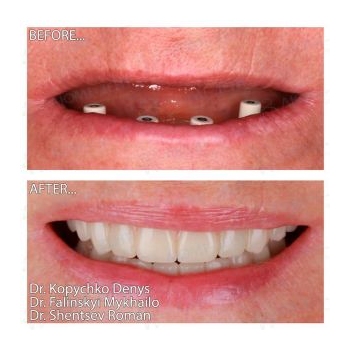 Straumann implants according to the All-on-4 and All-on-6 protocol