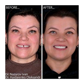 installation of 6 MegaGen implants on the upper and lower jaws