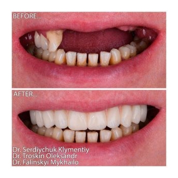 Zirconia prosthesis on a titanium bar All-on-6 Neodent