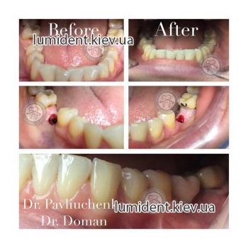 teeth implantation