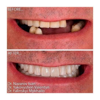 Zirconia dentures on titanium bars All-on-4 Neobiotech