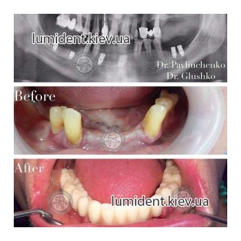 teeth implantation