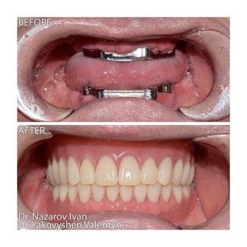 Prostheses on titanium bars All-on-4 MegaGen