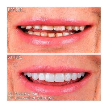 dental implant results
