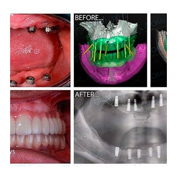 Full-Mouth Rehabilitation with Straumann All-on-6 Implants