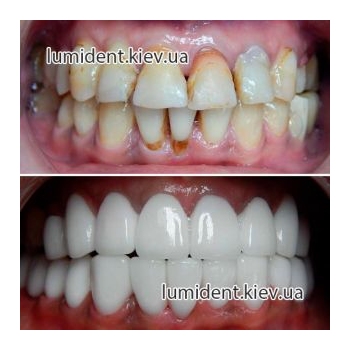 dental prosthesis