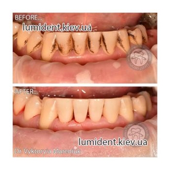 чистка зубів ультразвуком, фото, до і після