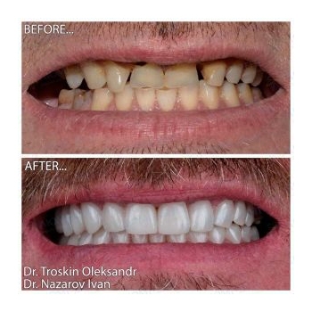Upper jaw implantation photos by Lumident