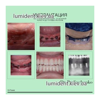 teeth implantation