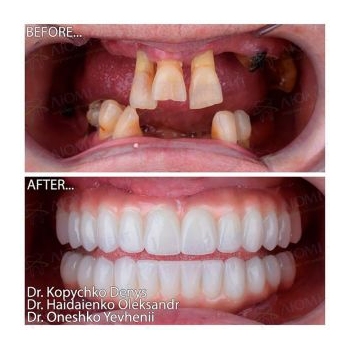 Total rehabilitation of both jaws on Straumann All-on-6 implants