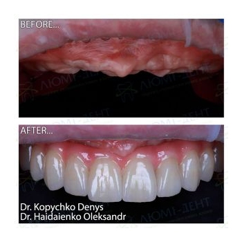 implant placement before and after