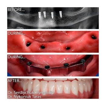 Dental implantation
