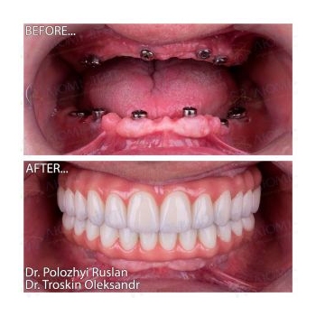 Full rehabilitation of both jaws with MegaGen implants
